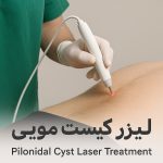 چرا لیزر کیست مویی انتخاب هوشمندانه تری نسبت به جراحی سنتی است؟