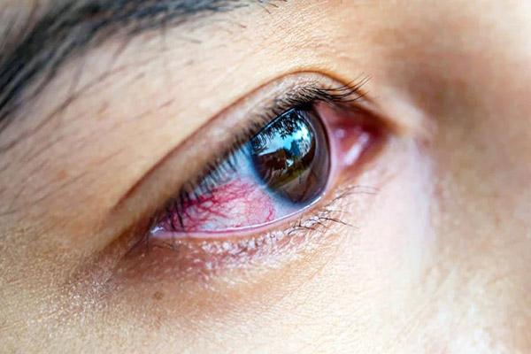 عوارض رایج و موقت تقویت کننده‌های مژه