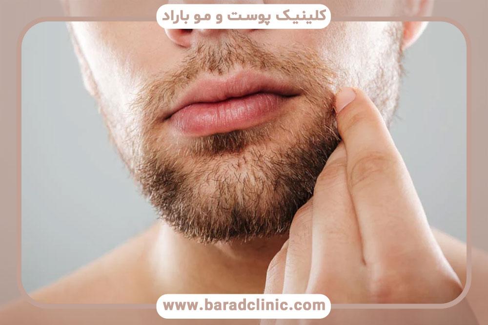 کاشت ریش