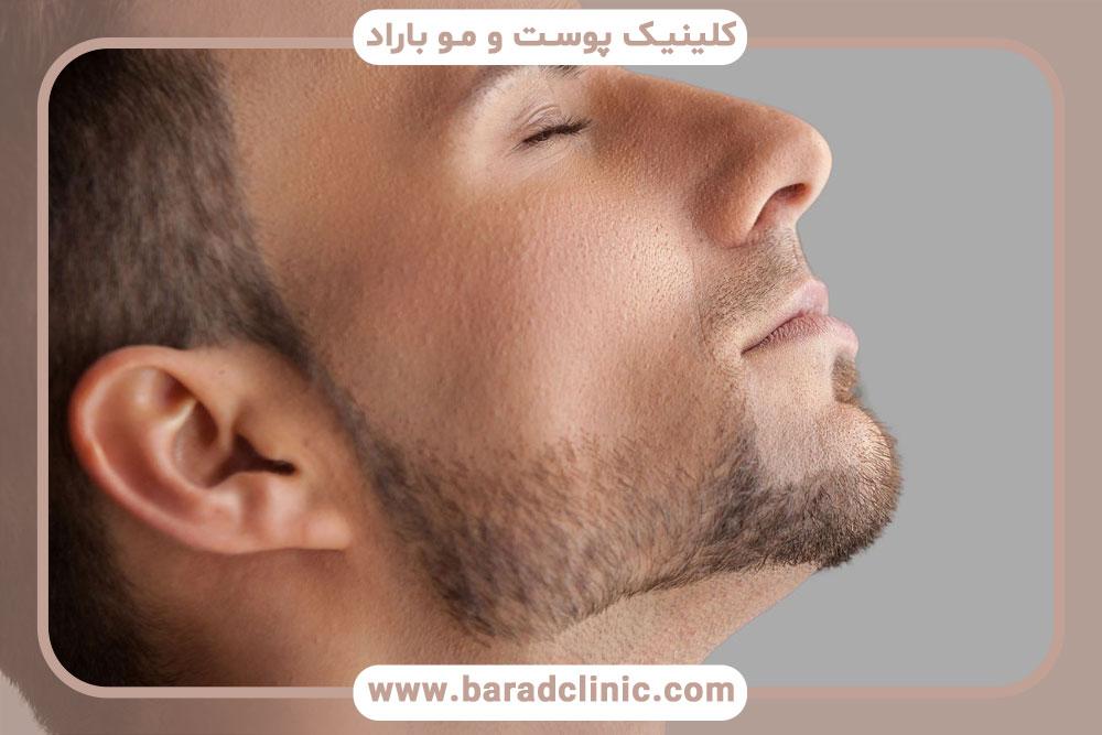 کاشت ریش