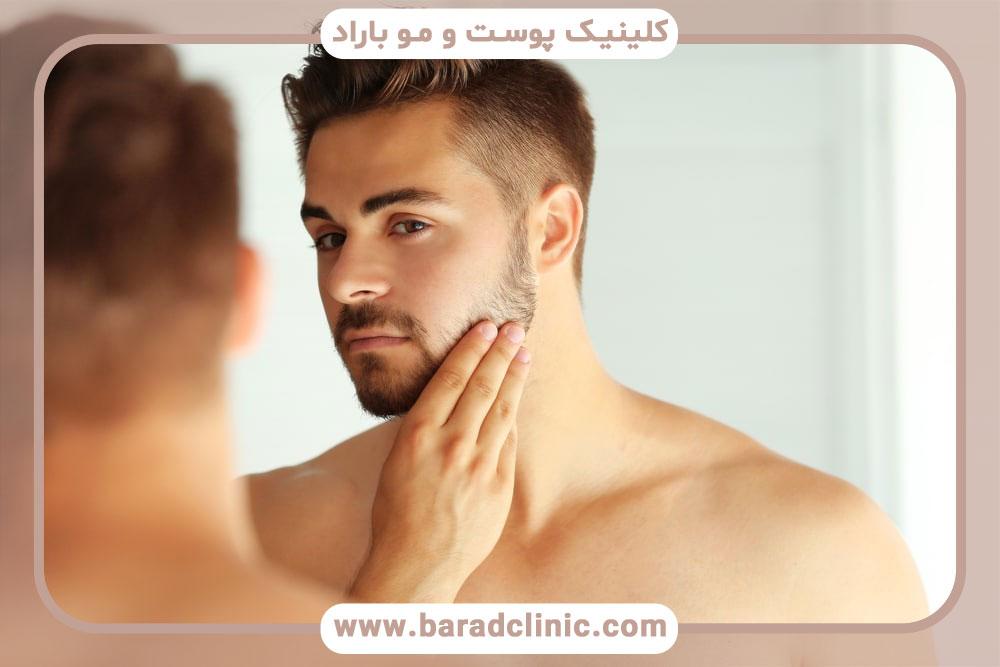 کاشت ریش