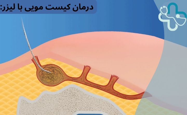 لیزر کیست مویی در هیوا لیزر