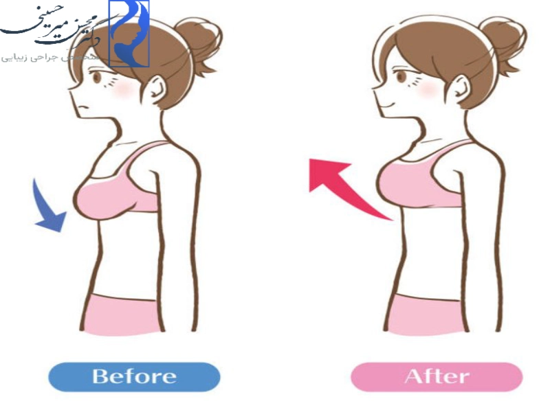 عمل ماموپلاستی