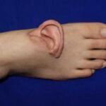 برای اولین بار؛ گوش به پا پیوند زده شد