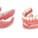 خداحافظی با لقی دندان مصنوعی؛ راهنمای جامع اوردنچر با ایمپلنت برای سالمندان