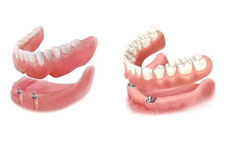 خداحافظی با لقی دندان مصنوعی؛ راهنمای جامع اوردنچر با ایمپلنت برای سالمندان