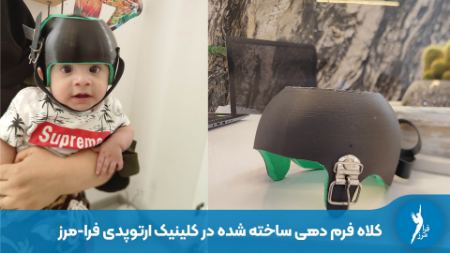 ساخت کلاه فرم دهی در کلینیک ارتوپدی فنی شیراز ساخت کلاه فرم دهی در کلینیک ارتوپدی فنی شیراز