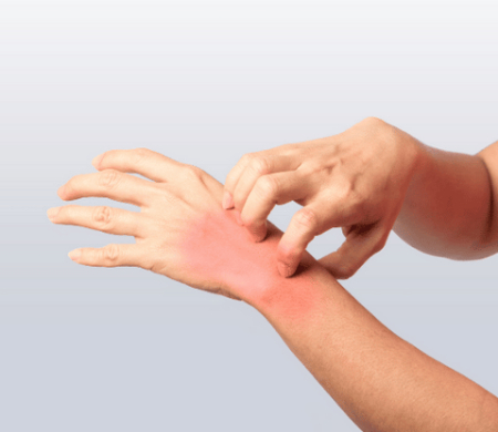 خارش انگشتان دست, درمان خارش انگشتان دست