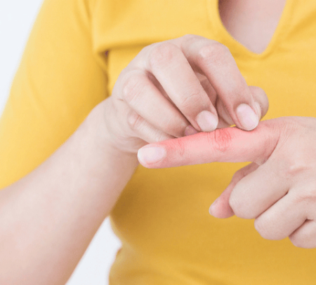 خارش انگشتان دست, درمان خارش انگشتان دست