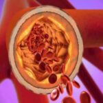 کلسترول تنها پیش‌بینی‌کننده بیماری قلبی نیست