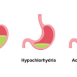 کمبود اسید معده یا هیپوکلریدریا؛ اختلالی خاموش در پشت بسیاری از مشکلات گوارشی مزمن
