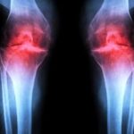 آزمایش موفقیت‌آمیز داروی جدیدی که می‌تواند «آرتروز» را درمان کند