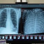 مردی ۴۸ ساعت بدون ریه زنده ماند!