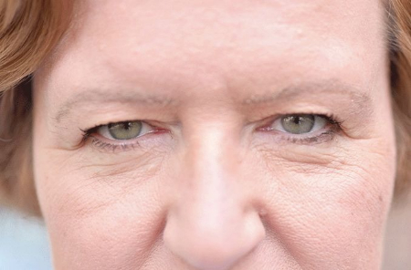 مشکلات رایج پلک که با افزایش سن ظاهر می‌شوند + درمان آن‌ها