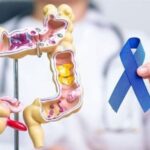 یک عامل ابتلای زودرس به سرطان روده بزرگ