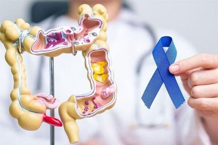 یک عامل ابتلای زودرس به سرطان روده بزرگ