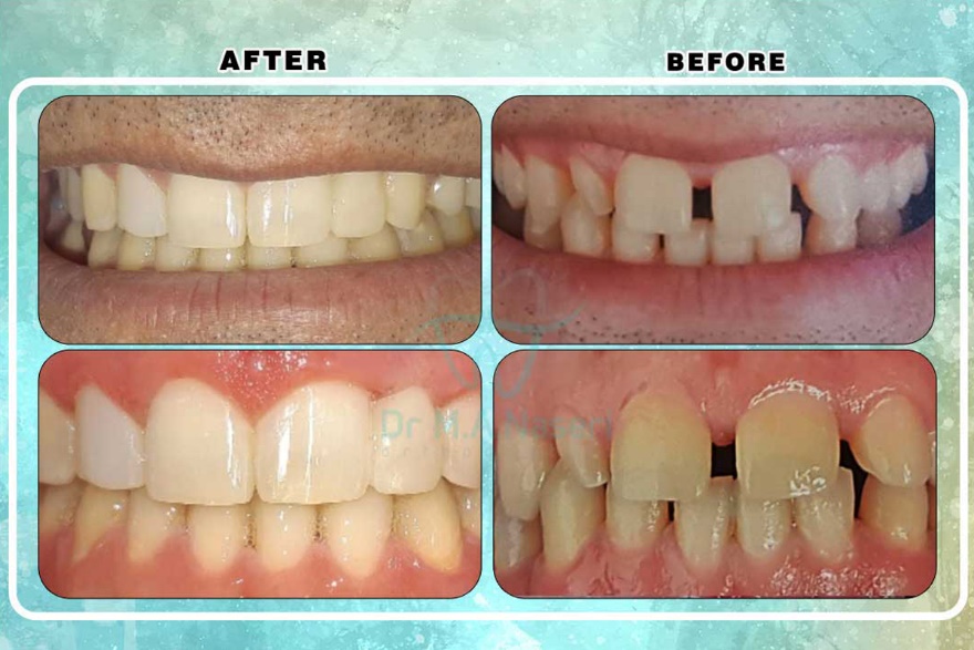 نمونه کار ارتودنسی بزرگسالان دکتر محمد علی ناصری