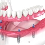 ایمپلنت کامل بر پایه 4 پیچ