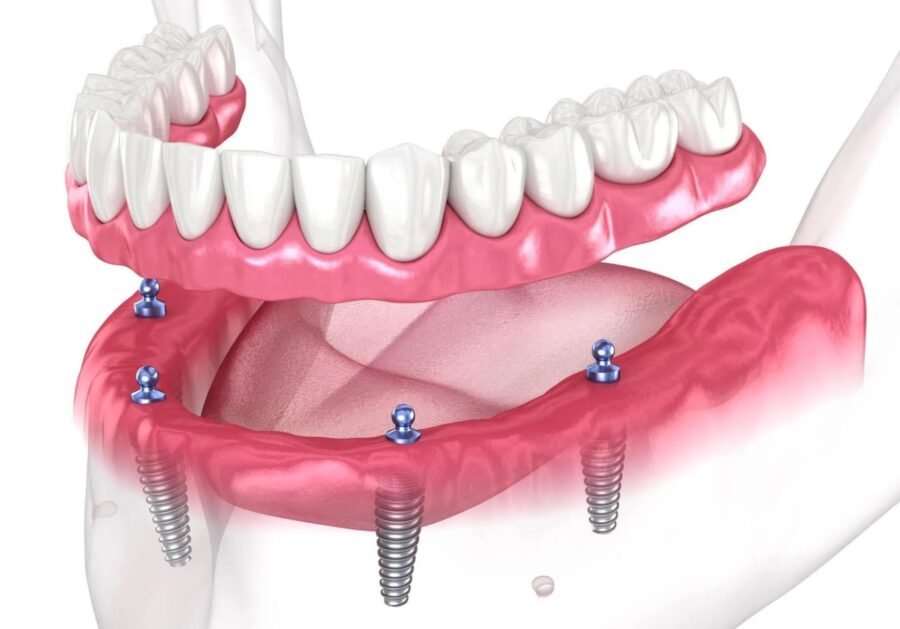 ایمپلنت کامل بر پایه 4 پیچ