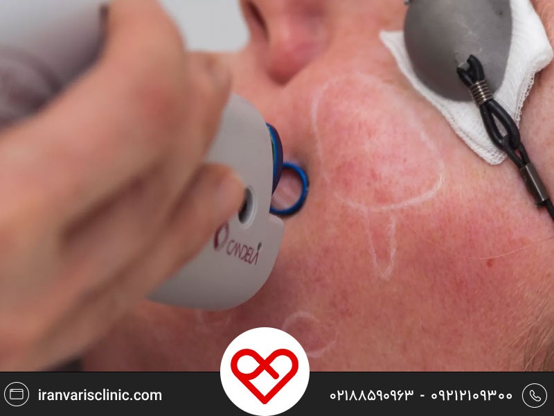درمان واریس صورت و اطراف چشم توسط لیزر