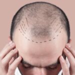 مراقبت‌های بعد از کاشت مو در شیراز و تأثیر آن بر تراکم نهایی