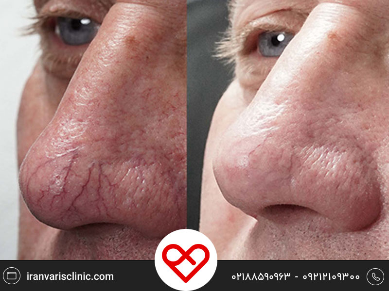 درمان واریس صورت و اطراف چشم توسط لیزر | راهکاری ایمن و موثر برای رفع رگ های قابل مشاهده واریس صورت