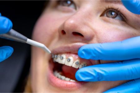 آیا ارتودنسی باعث تغییر فک می‌شود؟