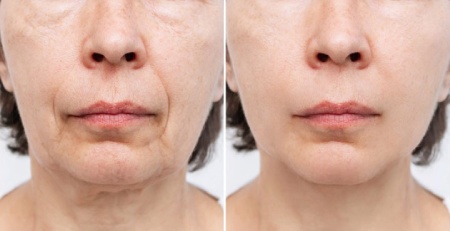 ماندگاری لیفت صورت ماندگاری لیفت صورت