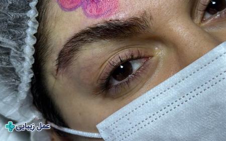 بهترین عمل‌های زیبایی با دوره نقاهت کوتاه برای انجام قبل از عید