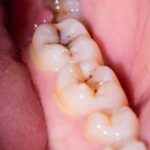 راز پوسیدگی دندان کشف شد