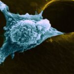 سرطان پایان راه نیست اگر زود تشخیص داده شود