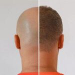 هزینه کاشت مو در تهران + قیمت انواع روش های کاشت مو در بهترین کلینیک تهران