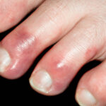 چیلبلین (پرنیو): التهاب عروقی پوست در مواجهه با سرما و رطوبت