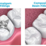 کدام پرکننده دندان ماندگارتر است؟ آمالگام یا کامپوزیت؟