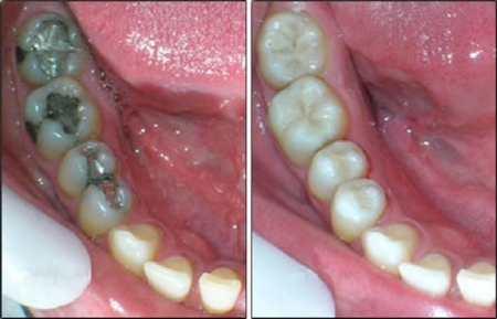 آمالگام یا کامپوزیت, پر کردن دندان با کامپوزیت