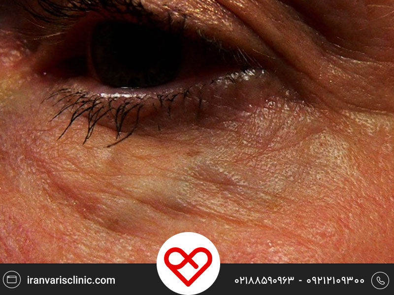 درمان واریس صورت و اطراف چشم توسط لیزر | راهکاری ایمن و موثر برای رفع رگ های قابل مشاهده واریس صورت و اطراف چشم