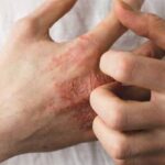 توصیه‌هایی درباره یک عارضه پوستیِ شایع