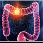 پیشگیری از سرطان روده بزرگ با راهکاری ساده