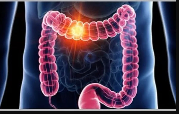پیشگیری از سرطان روده بزرگ با راهکاری ساده