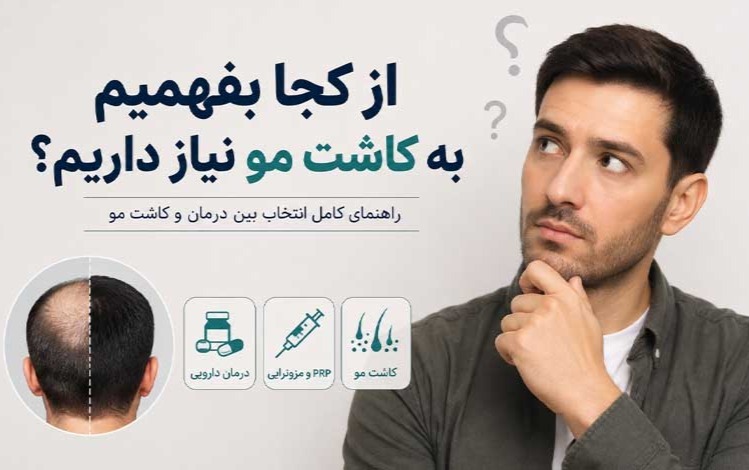 از کجا بفهمیم به کاشت مو نیاز داریم