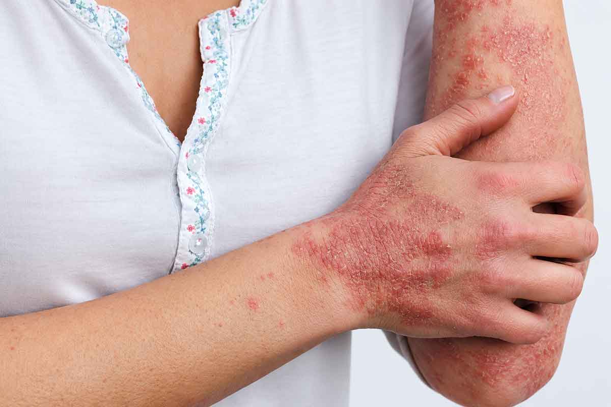پسوریازیس و دردسرهای پوست