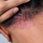 پسوریازیس و دردسرهای پوست