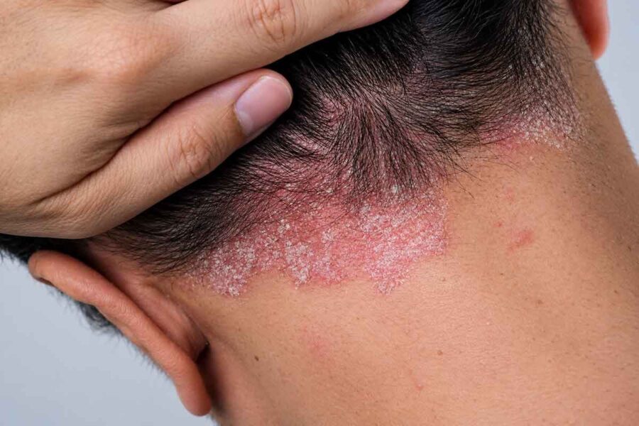 پسوریازیس و دردسرهای پوست