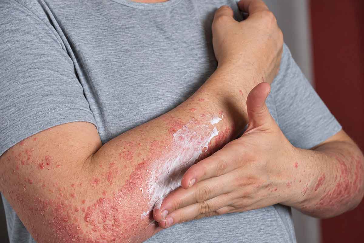 پسوریازیس و دردسرهای پوست